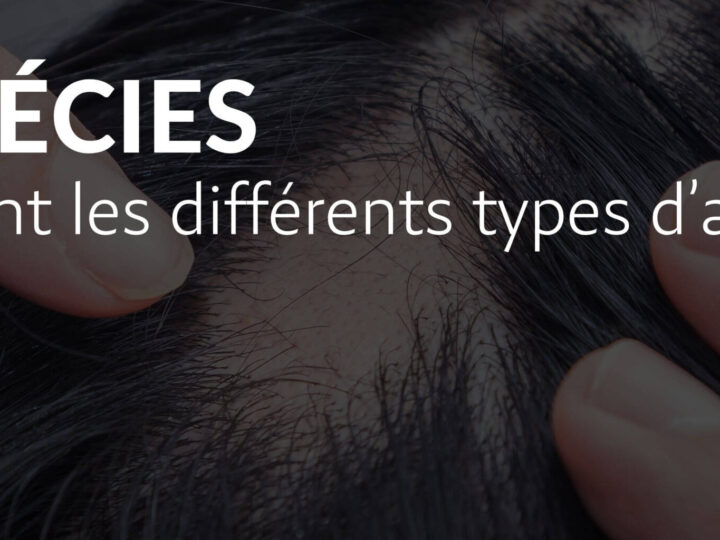 Quels sont les différentes formes d’alopécies ?